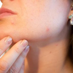 Τα σπυράκια έχουν την τάση να εμφανίζονται την χειρότερη στιγμή!