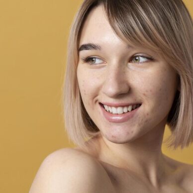 Ποια είναι τα συμπτώματα της ακμής; Αποτελεσματικοί τρόποι αντιμετώπισης